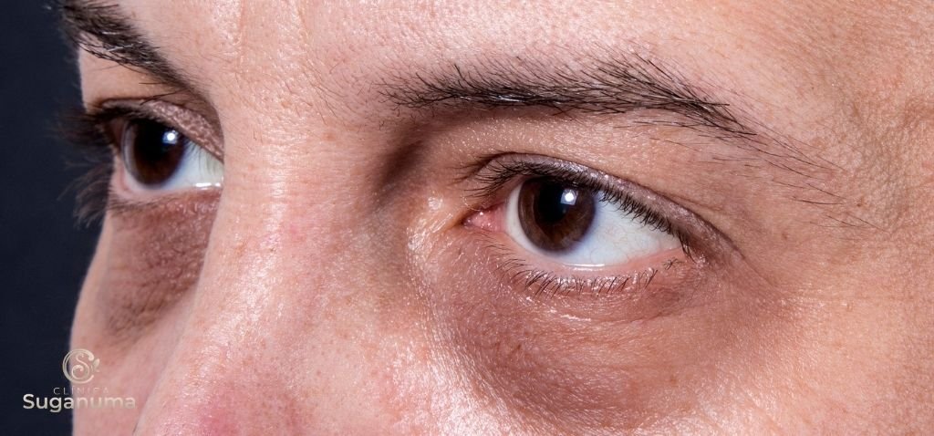 Os-tratamentos-para-as-olheiras-por-acumulo-de-pigmento-sao-seguros-e-sem-riscos-para-a-pele
