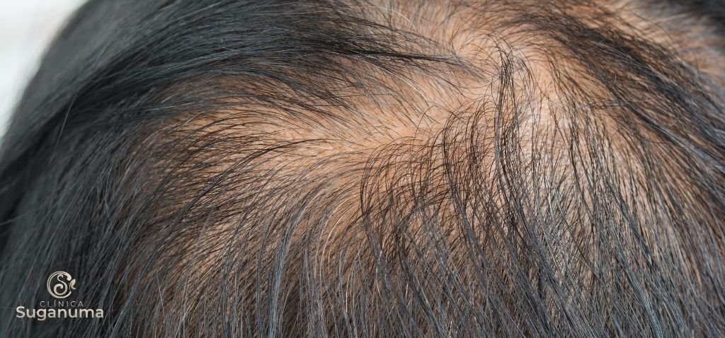 Existem-tratamentos-caseiros-para-o-afinamento-dos-fios-de-cabelo