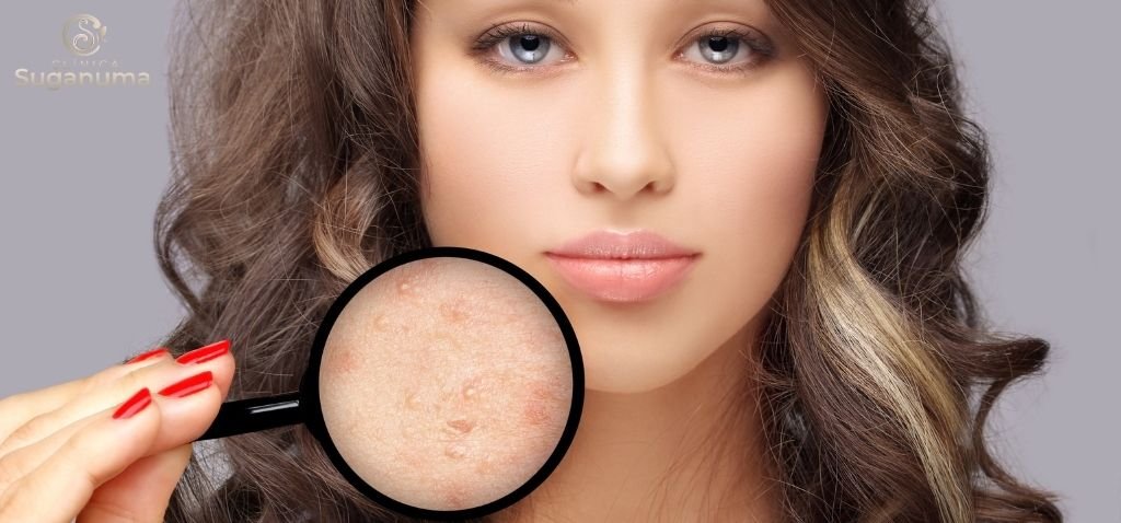 Ha-alguma-maneira-de-prevenir-o-desenvolvimento-de-cicatrizes-de-acne