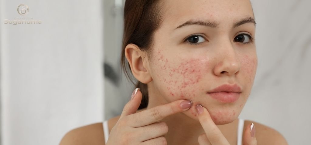 Ha-alguma-relacao-entre-a-dieta-e-o-desenvolvimento-de-acne