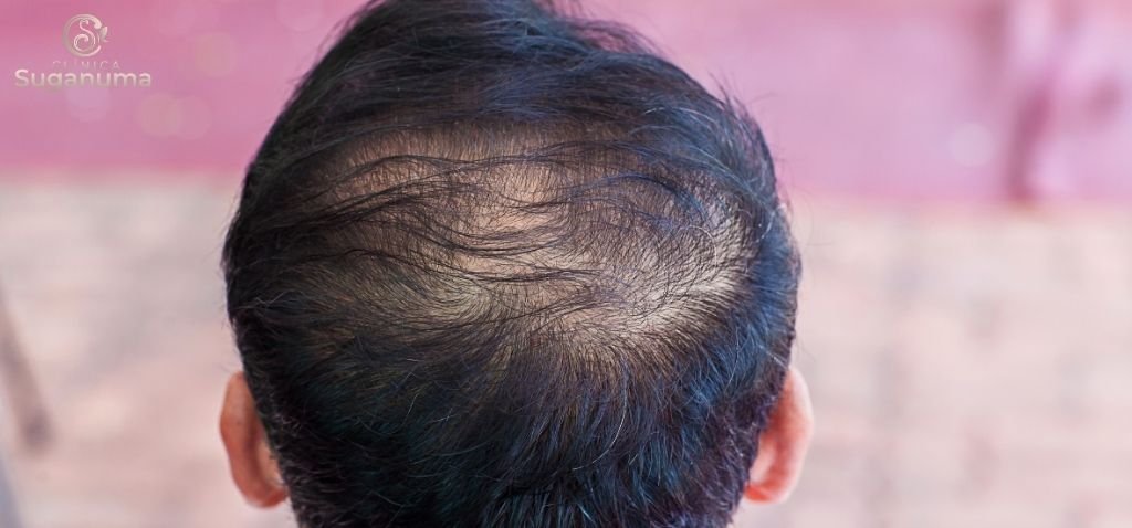 O-que-pode-causar-o-afinamento-dos-fios-de-cabelo-e-como-preveni-lo