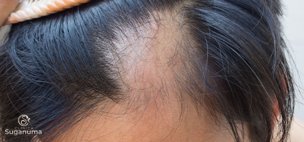 Existem-tratamentos-caseiros-para-a-falha-no-cabelo