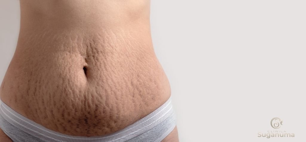 Existe-algum-tratamento-medico-disponivel-para-corrigir-ou-melhorar-as-estrias-vermelhas