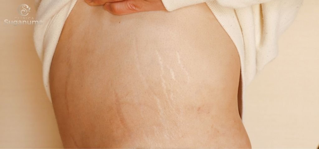 Ha-alguma-maneira-de-prevenir-o-desenvolvimento-de-estrias-brancas