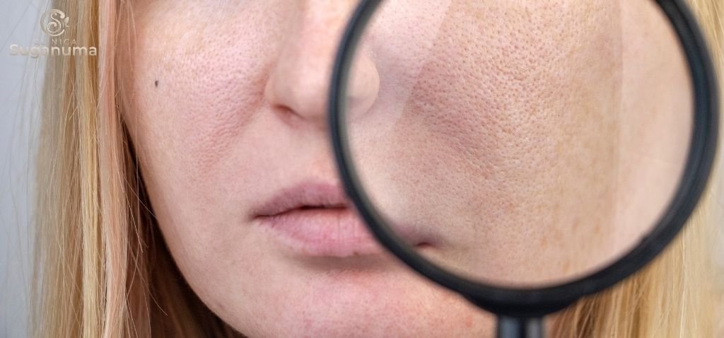 Os-tratamentos-para-os-poros-abertos-no-rosto-sao-seguros-e-sem-riscos-para-a-pele